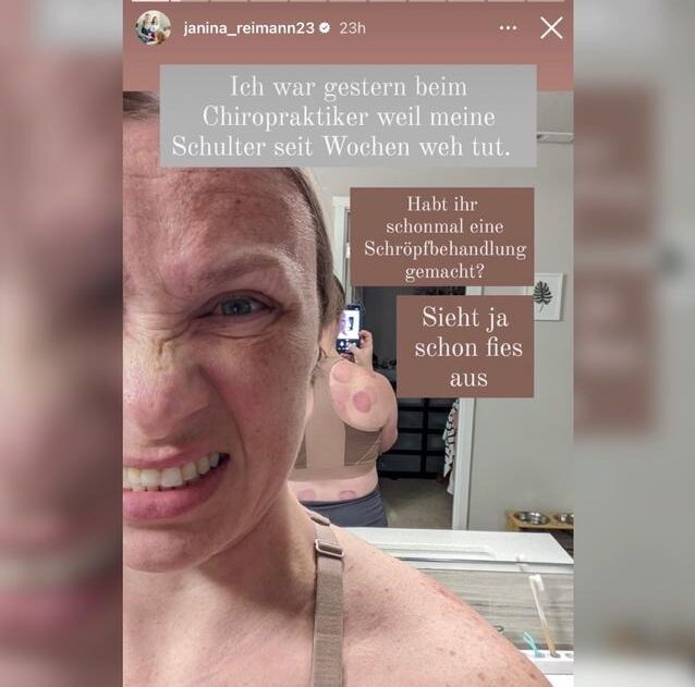 Autsch - Janina Reimanns Rücken sieht aber anders aus...  Foto: Instagram / Janina Reimann